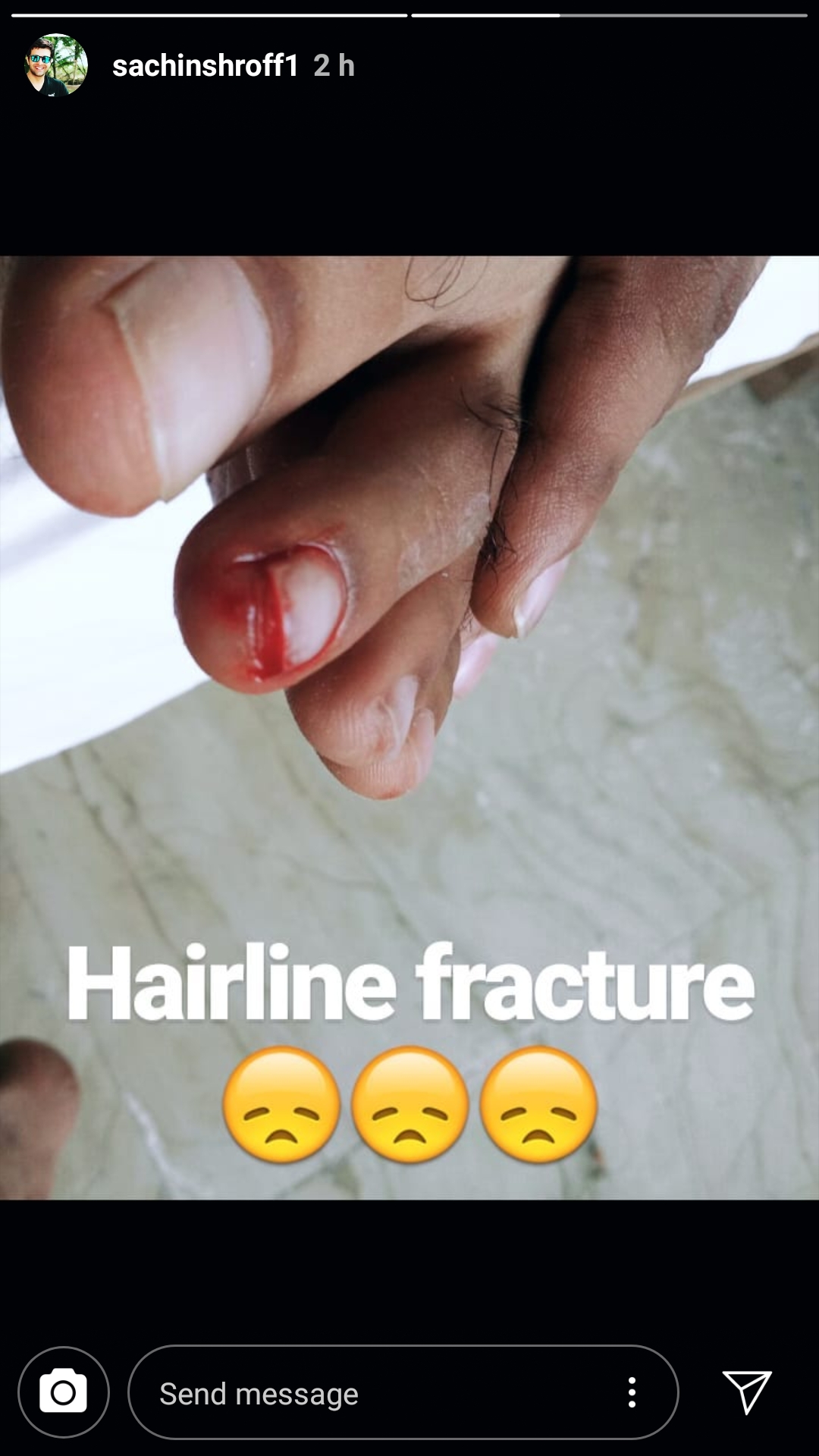 Sachin Shroff suffers hairline fracture 1