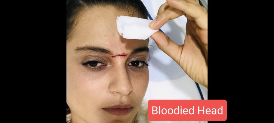 OMG: Kangana Ranaut shares picture of injured bloodied head