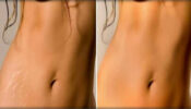 Try These 3 Home Remedies That Will Help You Get Rid Of Stretch Marks On Your Body