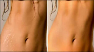 Try These 3 Home Remedies That Will Help You Get Rid Of Stretch Marks On Your Body