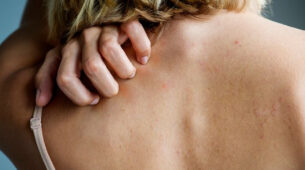 3 Ways To Deal With Skin Rashes