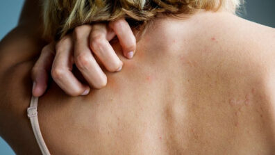 3 Ways To Deal With Skin Rashes