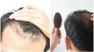 Want To Regrow Your Lost Hair? Here Are Some Of The Home Remedies With 100% Benefits