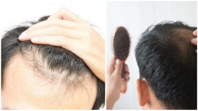 Want To Regrow Your Lost Hair? Here Are Some Of The Home Remedies With 100% Benefits