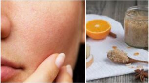 Home Remedies For Open Pores