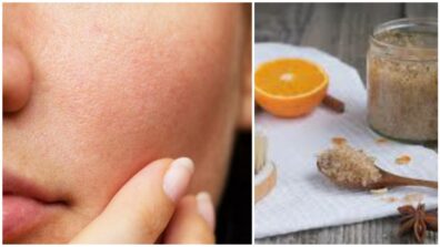 Home Remedies For Open Pores