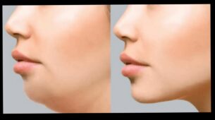 5 Exercises To Get Rid Of Bulgy Double Chin