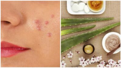 Home Remedies That Work Effectively For Pimples