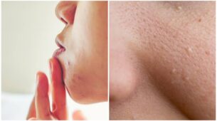 Get Rid Of Tiny Pimples & Bumpy Skin, See Homemade Remedy Here