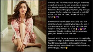 Yami Gautam reveals she’s dealing with ‘keratosis pilaris’ skin condition, deets inside
