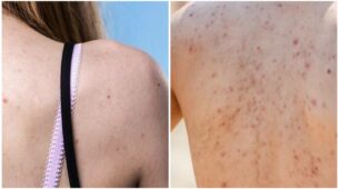 Tips And Tricks! Here’s How You Can Prevent And Get Rid Of Back Acne