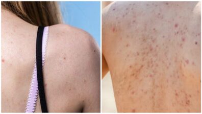 Tips And Tricks! Here’s How You Can Prevent And Get Rid Of Back Acne