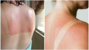 Worried About Tanning & Sunburns? Check Out How To Avoid It