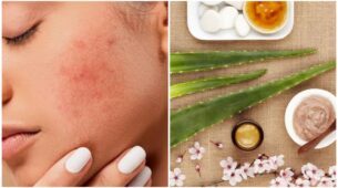 Reduce Redness From Pimples With These 4 Simple Home Remedies