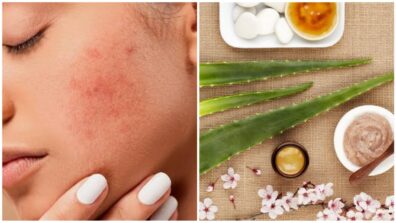Reduce Redness From Pimples With These 4 Simple Home Remedies