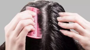 Homemade Dandruff Shampoo Recipe To Fight Dandruff Instantly
