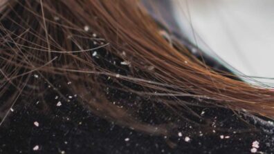 Get rid of itchy scalp and dandruff with these simple tips