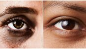 3 Easy Ways To Get Rid Of Dark Circles