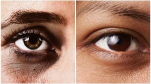 3 Easy Ways To Get Rid Of Dark Circles