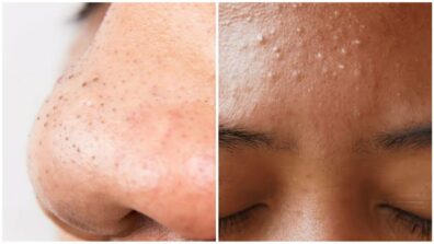 Easy Home Diy Remedies To Remove Blackheads & Whiteheads In Just 2 Mins, See Here