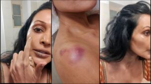 I fell down, got a deep cut, and ended up with few bruises on my hand – Flora Saini on injury while shooting