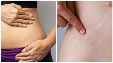 Fastest Way To Get Rid Of Stretch Marks Permanently