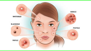 If You Have Acne-Prone Skin, You Should Follow THIS Routine