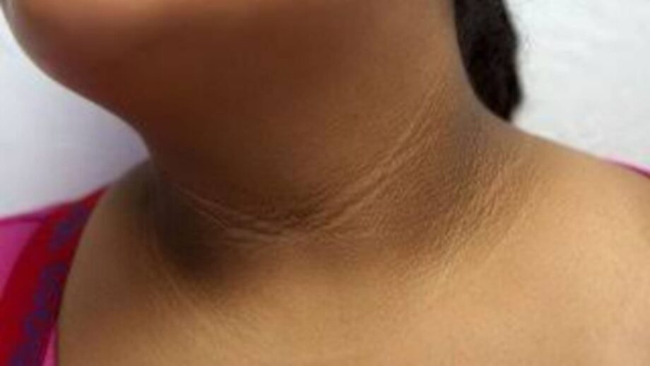Skincare Tip: Get Rid Of Dark Marks Around Your Neck Today 622047