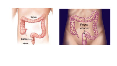 What Is Rectal Cancer: Symptoms And Causes