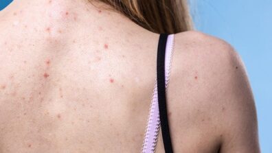 Bacne Alert: Suffering From Back Acne? We Got You