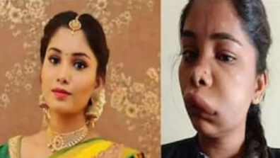 Kannada actress Swati Sathish’s root canal treatment leaves her face disfigured, pictures go viral