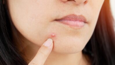 Stop: Before You Pop That Pimple, Here’s What You Should Know