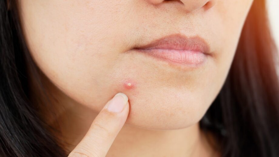 Stop: Before You Pop That Pimple, Here's What You Should Know 630290
