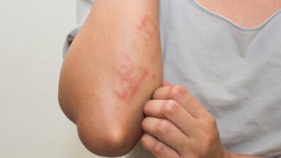 Summer Heat Giving You Rashes?