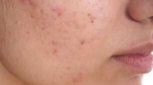 Causes of acne in the monsoon and ways to improve skin health