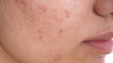 Causes of acne in the monsoon and ways to improve skin health