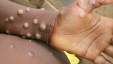 Everything about the viral Monkeypox disease, causes, and symptoms