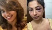 Malayalam actor Anicka Vikhraman accused ex-boyfriend of abuse, see shocking snaps of bruises